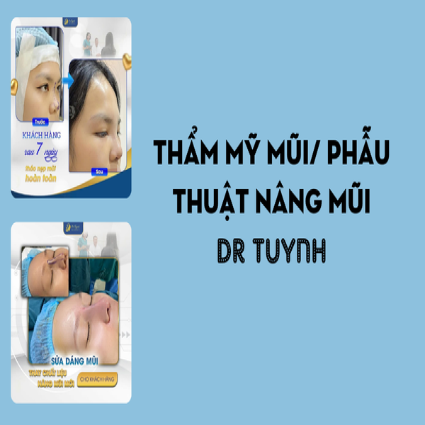 Phẫu thuật nâng mũi Dr Tuynh: Đẹp tự nhiên, tái tạo mũi hỏng